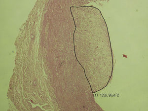 Determinación del área de aterosclerosis.
