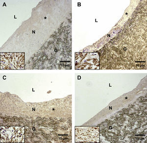 La formación de hiperplasia neointimal representativa en la anastomosis distal se redujo significativamente en animales pertenecientes a los subgrupos D comparados con los otros subgrupos (grupos 1 y 2, control, A y C). En los animales del grupo 2, subgrupo D, la formación de hiperplasia neointimal fue más pronunciada (D) comparado con el grupo 1, subgrupo D (B). G: material del injerto de PTFEe (magnificación original x 10); L: luz; N: neoíntima. Los insertos (ángulo inferior izquierdo) muestran con mayor magnificación que la mayoría de las células de la neoíntima son positivas para la tinción con alfa-actina (magnificación original, x 40).