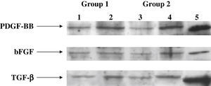 Análisis de inmunoelectrotransferencia para determinación de PDGF, bFGF y TGF-beta1 en los medios condicionados de los injertos de PTFEe en la anastomosis distal. Como controles positivos se usaron PDGF, bFGF y TGF-beta1 recombinantes humanos (carril 5). En los subgrupos D, los niveles de proteínas de PDGF, bFGF y TGF-beta1 disminuyeron significativamente (carriles 1 y 3) comparado con los otros grupos (carriles 2 y 4, controles) (p < 0,001). En los subgrupos D, en las prótesis tratadas con células endoteliales y Matrigel (carril 3 comparado con 1), se produjo una cantidad significativamente mayor de proteína (p < 0,004). bFGF: factor básico de crecimiento fibroblástico; Group: grupo; PDGF-BB: factor de crecimiento BB derivado de las plaquetas; TGF- β1: factor de crecimiento transformante beta1.