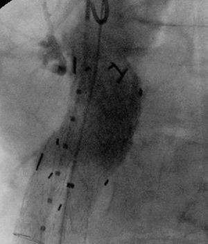 La aortografía de comprobación demuestra el sellado completo de la endofuga tras desplegar el cuff aórtico.