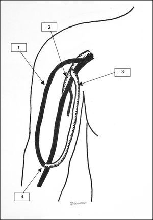 Técnica de la PFA (AH braquial). 1: vena cefálica; 2: arteria axilar; 3: implante protésico (PTFE); 4: anastomosis distal entre la vena y la prótesis.
