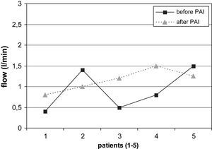 Flujo de la fístula en pacientes con AH en la muñeca antes y después de la PFA (reducción no significativa del flujo sanguíneo). after PAI: después del flujo arterial aferente; before PAI: antes del flujo arterial aferente; flow (l/min): flujo (l/min); patients (1-5): pacientes (1-5).
