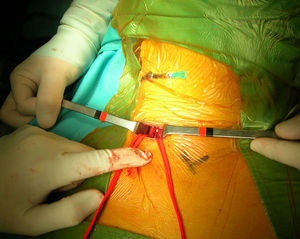 Imagen operatoria que muestra la arteria carótida común y la vena yugular después de la disección y antes de la inserción del introductor. Obsérvese la aguja colocada sobre la piel para identificar la bifurcación carotídea.