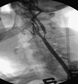 Angiografía intraoperatoria que muestra la estenosis de la arteria carótida interna antes del drenaje del contraste en el introductor de la vena (a la derecha). Obsérvese la visualización fluoroscópica de la aguja colocada sobre la bifurcación carotídea.