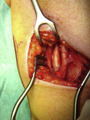 Resultado postoperatorio después de la ablación adventicial de la arteria carótida externa. La porción de 3cm proximales de la arteria permanece circunferencialmente “desnuda”.