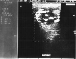 Eco-Doppler de flujo color mostrando un TCC.