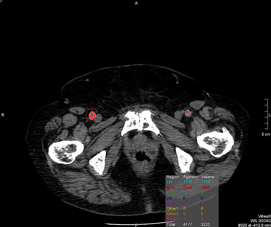 Tratamiento endovascular de aneurismas aórticos abdominales mediante ...