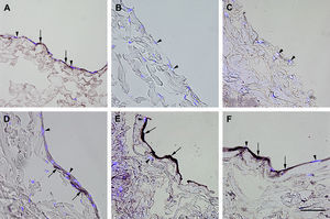 Inmunotinción con anticuerpos dirigidos a fvW. Imágenes representativas de las secciones transversales que muestran las células cultivadas en una estructura de gelatina durante 10 días, inmunoteñidas usando antisueros dirigidos a fvW. Su expresión se manifestó en las células endoteliales (A), fibroblastos diferenciados hacia un tipo de célula similar a la endotelial en la estructura (D), fibroblastos diferenciados hacia un tipo de célula similar a la endotelial antes de su siembra en la estructura (E), y fibroblastos de clonas de células individuales diferenciados hacia un tipo de célula similar a la endotelial en la estructura (F). Obsérvese la presencia de inmunorreactividad, indicada por las flechas. No se detectó inmunorreactividad en los fibroblastos de control (B, C). La tinción DAPI se usó para visualizar los núcleos de las células (puntas de flecha). Barra de escala = 50 μm para todas las imágenes.