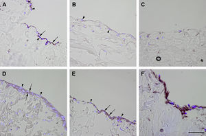 Inmunotinción con anticuerpos dirigidos hacia ve-cadherina. Imágenes representativas de las secciones transversales que muestran las células cultivadas en una estructura de gelatina durante 10 días, inmunoteñidas usando antisueros dirigidos a ve-cadherina. Su expresión se manifestó en las células endoteliales (A), fibroblastos diferenciados hacia un tipo de célula similar a la endotelial en la estructura (D), fibroblastos diferenciados hacia un tipo de célula similar a la endotelial antes de su siembra en la estructura (E), y fibroblastos de clonas de células individuales diferenciados hacia un tipo de célula similar a la endotelial en la estructura (F). Obsérvese la presencia de inmunorreactividad, indicada por las flechas. No se detectó inmunorreactividad en los fibroblastos de control (B, C). La tinción DAPI se usó para visualizar los núcleos de las células (puntas de flecha). Barra de escala = 50 μm para todas las imágenes.