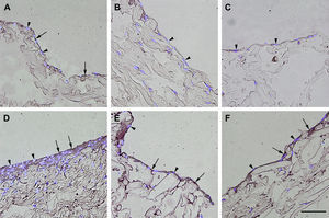 Inmunotinción con anticuerpos dirigidos hacia el receptor B2 de la bradicinina. Imágenes representativas de las secciones transversales que muestran las células cultivadas en una estructura de gelatina durante 10 días, inmunoteñidas usando anticuerpos antirreceptor B2 de la bradicinina. Su expresión se manifestó en las células endoteliales (A), los fibroblastos diferenciados hacia un tipo de célula similar a la endotelial en la estructura (D), fibroblastos diferenciados hacia un tipo de célula similar a la endotelial antes de su siembra en la estructura (E), y fibroblastos de clonas de células individuales diferenciados hacia un tipo de célula similar a la endotelial en la estructura (F). Obsérvese la presencia de inmunorreactividad indicada por las flechas. No se detectó inmunorreactividad en los fibroblastos de control (B, C). La tinción DAPI se usó para visualizar los núcleos de las células (puntas de flecha). Barra de escala = 50 μm para todas las imágenes.