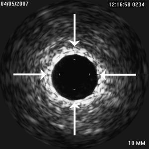 Imagen obtenida con el examen ecográfico intravascular que muestra la correcta expansión del stent (flechas).