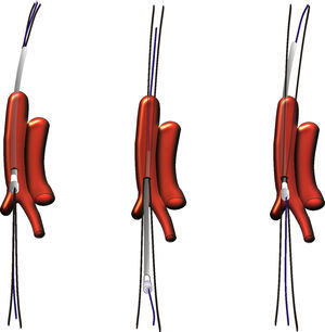 EL dibujo muestra en tres pasos la maniobra que separa las guías sobre la línea de arteriotomía.