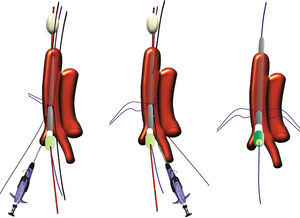 Procedimiento de inserción de los dispositivos Proglide sobre las guías laterales y cómo la localización de las suturas longitudinales interrumpidas depende del diámetro de la guía central.