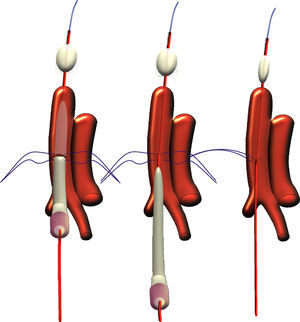 El sistema de distribución se recupera al mismo tiempo que se anudan las suturas. El catéter de embolectomía permite un control de la hemostasia sin problemas.