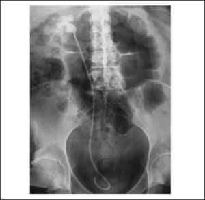 Urografía intravenosa que muestra un gran cálculo coraliforme en el riñón derecho, probablemente secundario al tratamiento con topiramato.