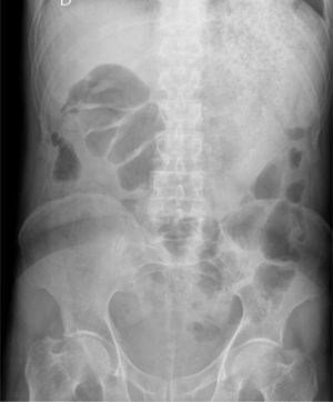 Radiografía simple de abdomen antes del tratamiento. Se observa un patrón en miga de pan distribuido por el cuadrante superior izquierdo, correspondiente a la cavidad gástrica ocupada por el fitobezoar, que desplaza hacia abajo al colon.