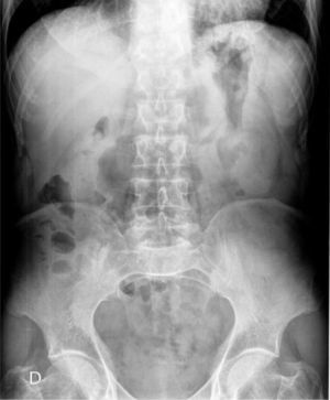 Radiografía simple de abdomen tras el tratamiento con celulasa. El área gástrica se halla aireada y sin contenido sólido.