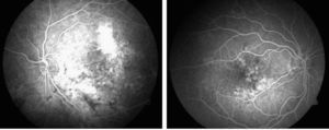 Izquierda: angiografía (AGF) del ojo izquierdo en el mes de agosto. Derecha: AGF del ojo derecho en el mes de agosto.