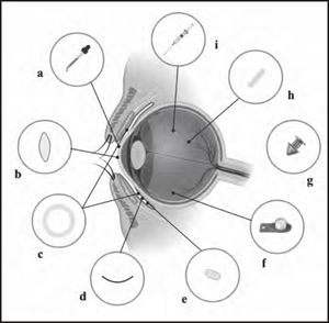New ophthalmic drug delivery systems | Farmacia Hospitalaria