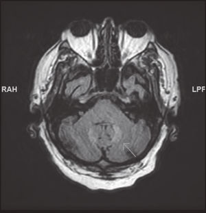 Brain MRI showing bilateral alteration of the dentate nuclei.