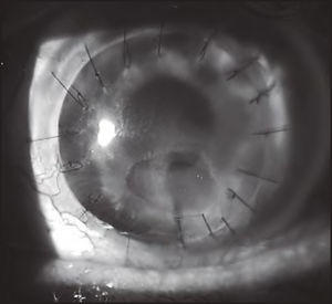 Eye photograph before treatment with topical insulin (December 2019).