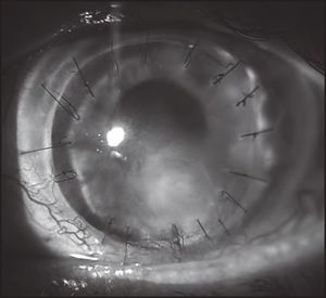 Eye photograph after treatment with topical insulin (February 2020).