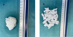 Observation of the 5 cm x 6 cm pharmacobezoar formed at 24 h after starting immersion (a) and attempting to break the pharmacobezoar using a crystal stick (b).