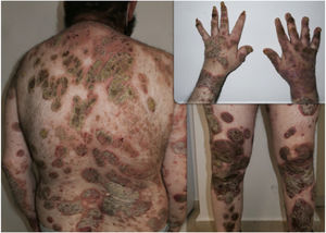 Erythematous, scaly plaques on the trunk and limbs (July 2020).