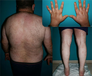 Complete clearing of psoriasis and control of associated arthropathy after 44 weeks of guselkumab treatment.