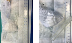 Examen visual de la formación de un farmacobezoar compuesto por 47 comprimidos LP de 500 mg de divalproato sódico. a) Todos se congregaron en una sola bolsa tras una incubación de 2 horas en un fluido gástrico simulado y b) comparación con un tubo de lavado orogástrico 30F.
