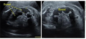 Intestino fetal dilatado a las 27 semanas de gestación antes de la terapia materna.