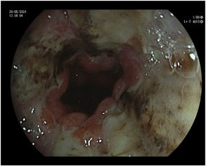 Endoscopic findings of the oesophagus.
