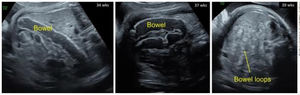Dilated foetal intestine at 34 and 37 weeks of gestation (3 and 6 weeks after starting maternal therapy, respectively), and resolved dilated foetal intestine at 39 weeks of gestation (8 weeks after starting treatment).
