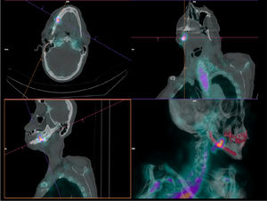 Leukocyte scintigraphy with [99mTc]Tc-exametazime-labeled leukocytes. Intense focal uptake of leukocytes in right mandibular osteosynthesis material, in keeping with a known active infectious process. Source: authors (courtesy of Hospital Clínic de Barcelona).