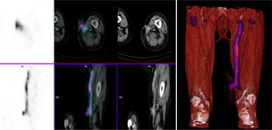 Scintigraphy with leukocytes labeled with [111In]In-oxine. Pathological leukocyte uptake is observed due to infection of a vascular prosthesis. Source: authors (courtesy of Hospital Clínic de Barcelona)).