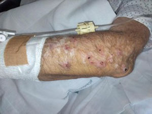 Lesiones de prurigo nodular en antebrazo izquierdo.