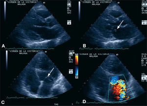 Mujer de 52 años que ingresa por EAP en contexto de un infarto agudo de miocardio inferior, con hipocinesia inferior y prolapso sistólico de una parte del músculo papilar (flechas en B y C) con regurgitación mitral aguda muy severa (D) (ecocardiograma transtorácico).