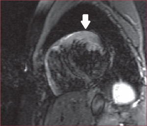 Secuencia STIR (potenciada en T2) que muestra la extensión del edema miocárdico (flecha).