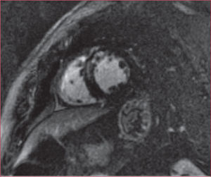 Secuencia de realce tardío miocárdico que muestra un infarto con obstrucción microvascular.
