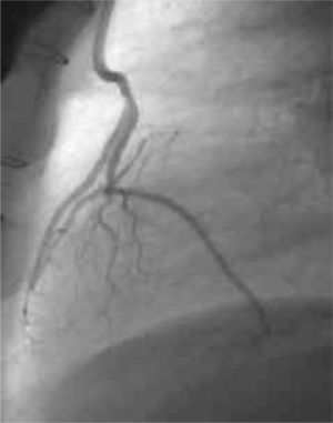 Angiografía de control a 6 meses de la intervención. Derivación de arteria mamaria izquierda a descendente anterior permeable. Derivación de arteria mamaria derecha a circunfleja en «Y» desde la arteria mamaria izquierda, permeable.