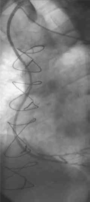Angiografía de control a 6 meses de la intervención. Derivación venosa a coronaria derecha permeable. Obsérvese la anastomosis proximal terminoterminal de la derivación venosa con el pedículo remanente de la mamaria derecha.