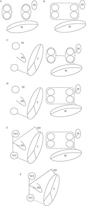Patrones de lesiones quirúrgicas de ablación en la fibrilación auricular. a: aislamiento selectivo venas pulmonares. B: Box-lesion. C: Maze IV. D: mini Maze. E: Maze III. F: Maze derecho.