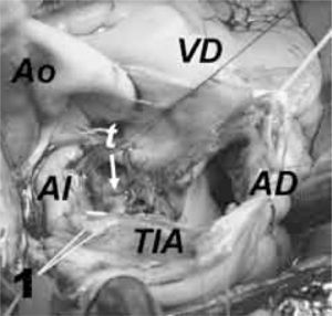 Vista craneal de la incisión a través del techo de ambas aurículas. AD: aurícula derecha; AI: aurícula izquierda; TIA: tabique interauricular; T: tumor; Ao: aorta; VD: ventrículo derecho