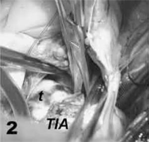 Imagen de la maniobra de resección del septo de forma completa. TIA: tabique interventricular; T: tumor.
