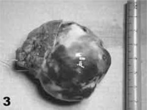 Imagen de la pieza quirúrgica extirpada en uno de nuestros pacientes, en el que resultó ser un mixoma encapsulado, con base de implantación septal amplia.