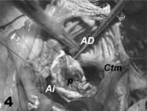 Detalle de la reconstrucción del defecto septal con parche de pericardio autólogo. AI: aurícula izquierda; AD: aurícula derecha; p: parche de pericardio; CTm: crista terminalis.