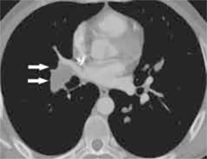 La imagen de TC con contraste endovenoso muestra un defecto de repleción en arteria pulmonar de lóbulo inferior derecho que aumenta el diámetro del vaso sugestivo de embolismo pulmonar no trombótico (flecha).