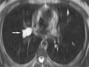RM potenciada en T2 (secuencia single shot fast pin echo [SSFSE]). En el corte axial se observa la gran hiperintensidad del trombo situado en el interior de la arteria pulmonar sugestivo de un contenido quístico del mismo (flecha).