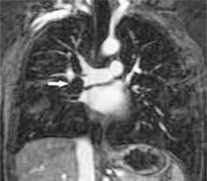 Angio-RM de arterias pulmonares. Se observa un defecto de repleción en arteria pulmonar derecha (flechas) que produce un defecto de perfusión en lóbulo inferior derecho.