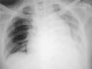 Imagen preoperatoria. Se observa el gran tamaño del perfil correspondiente a la arteria pulmonar.